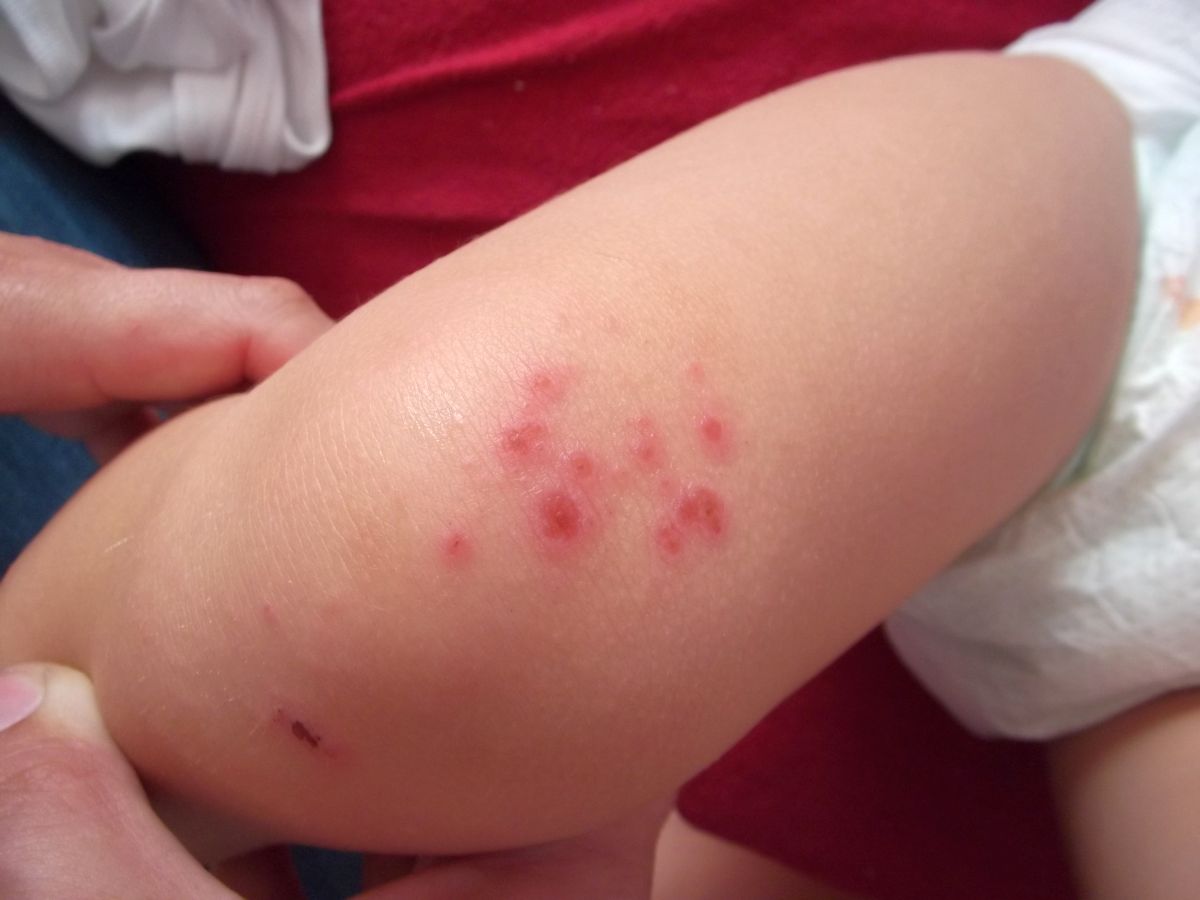 Piqûre de punaise de lit sur une jambe d'enfant